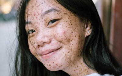 Cztery znaki, że kwasy są za mocne dla twojej skóry