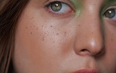 Maskne: Jak skutecznie leczyć wypryski od maseczki